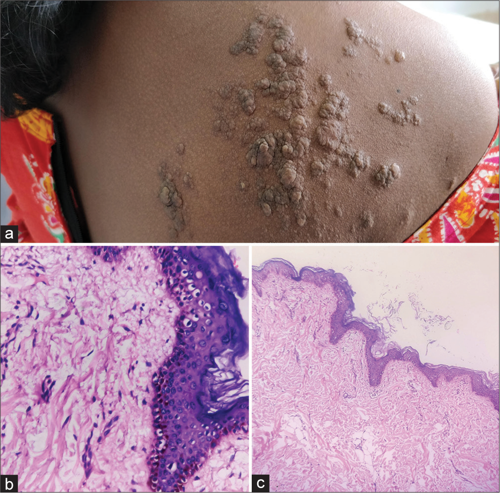 Nevus lipomatosus cutaneous superficialis - An odd site