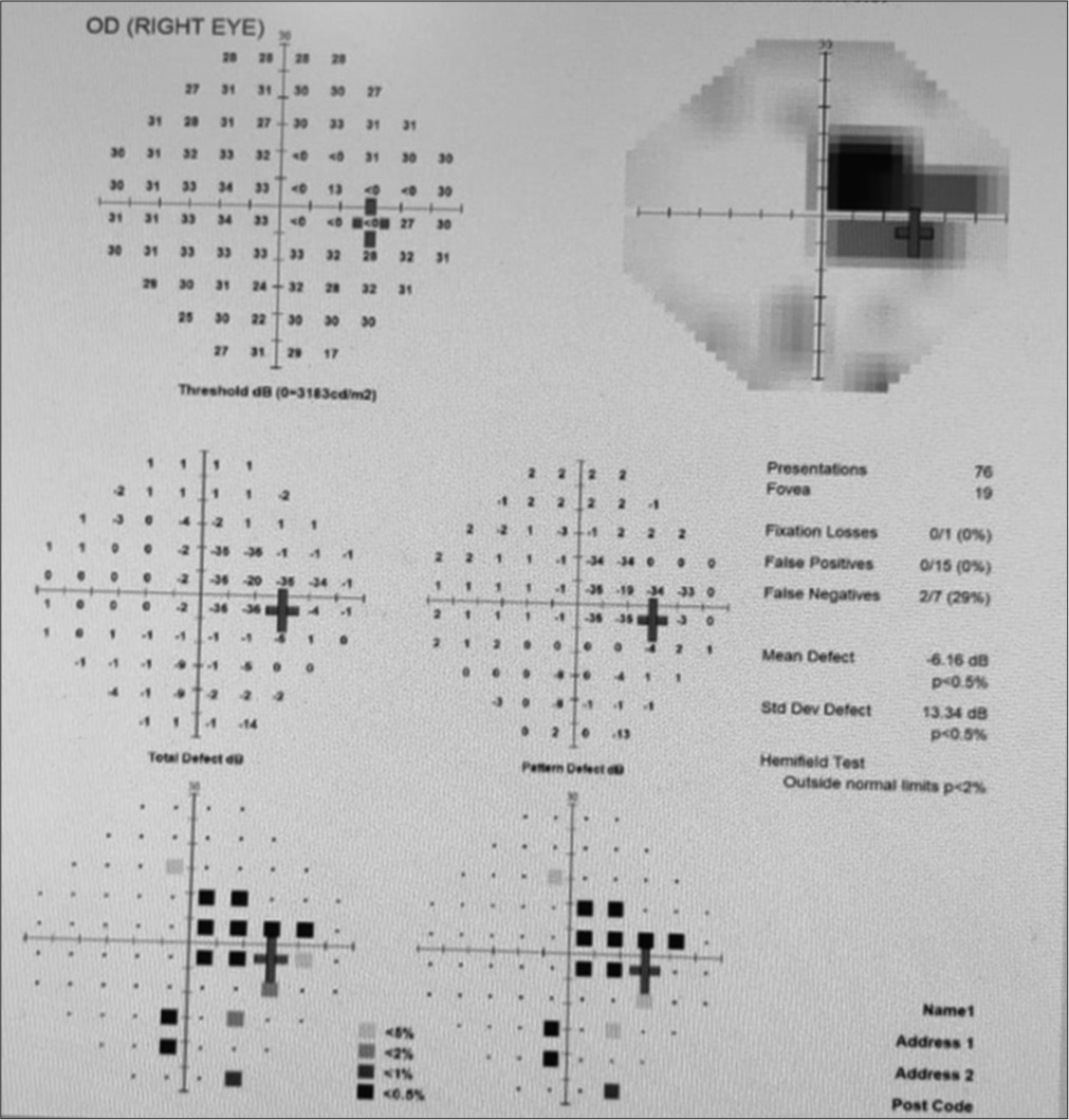 Leber’s idiopathic stellate neuroretinitis - A clinical case