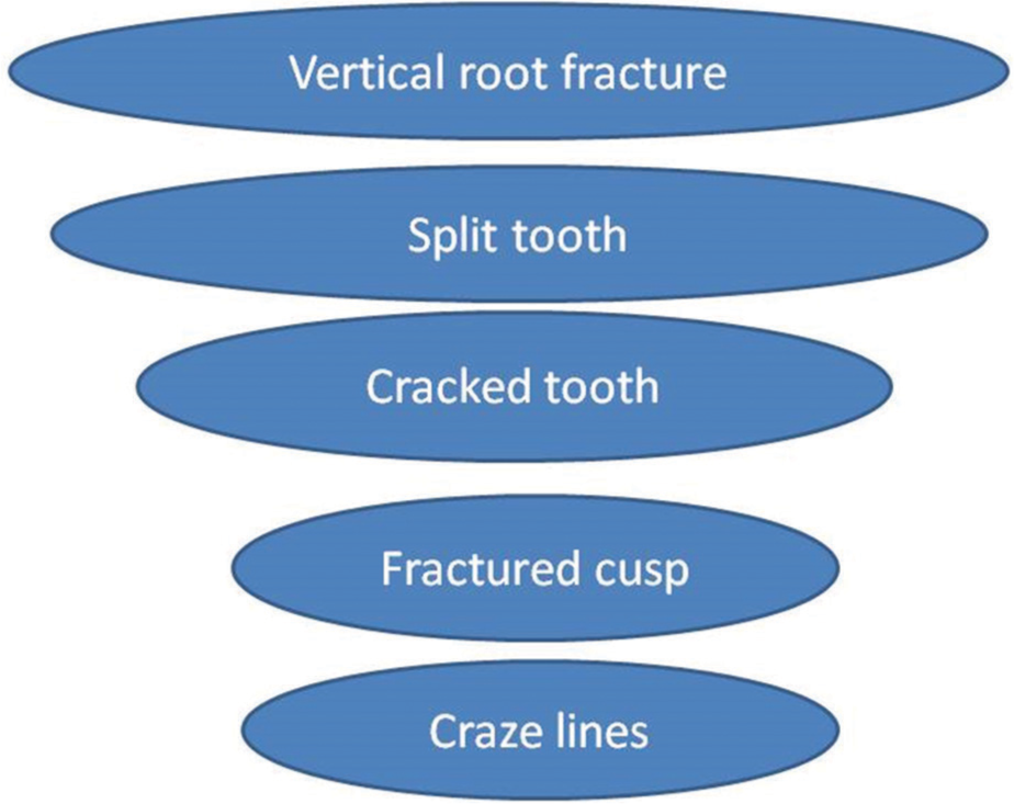 Longitudinal tooth fracture indicating a questionable prognosis for an endodontist