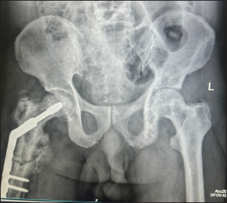 A case report on the comprehensive management of recurrent fractures in polyostotic Paget’s disease