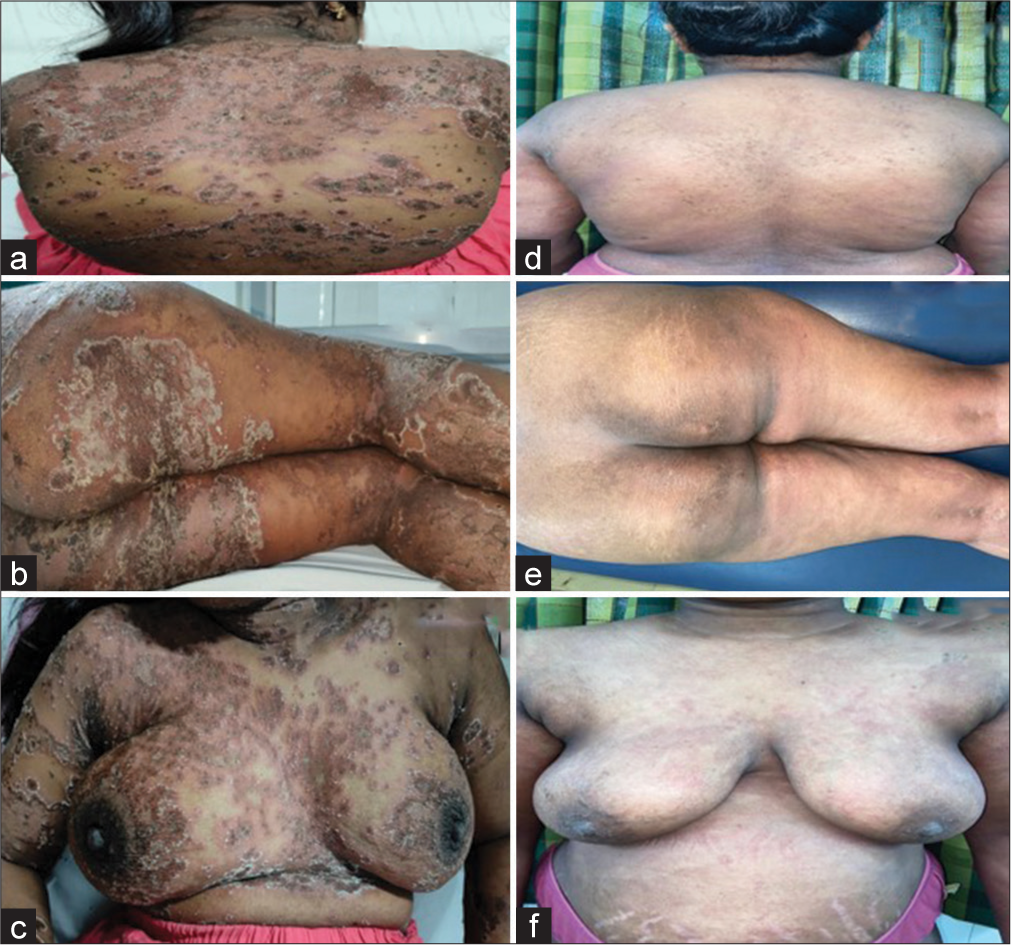 Pustular Psoriasis of Pregnancy Successfully Managed with Steroid and Cyclosporine – A Case Report