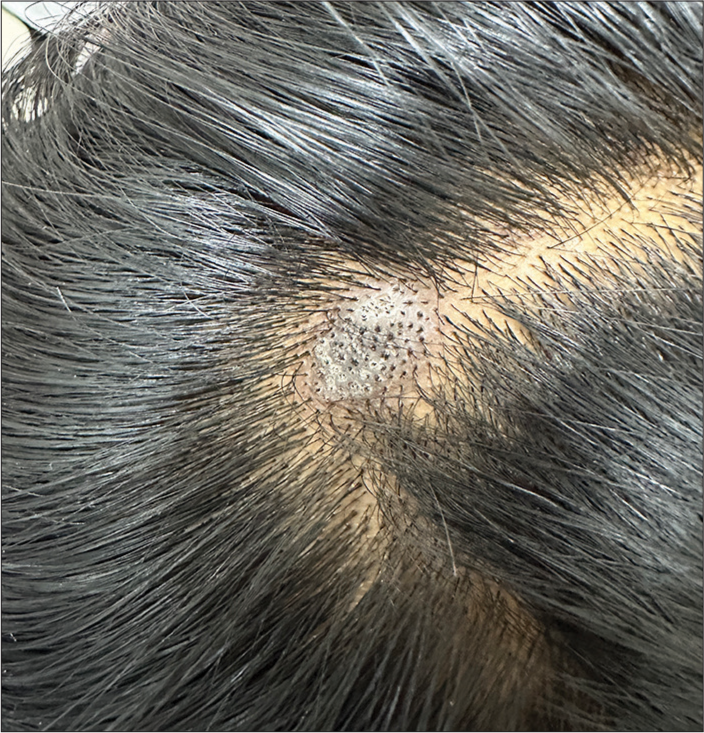 Trichoteiromania Presenting as a Patch of Localised Hair Loss: A Diagnostic Challenge