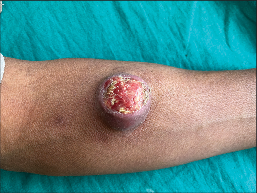 Giant Ulcerating Pilomatricoma: A Case Report