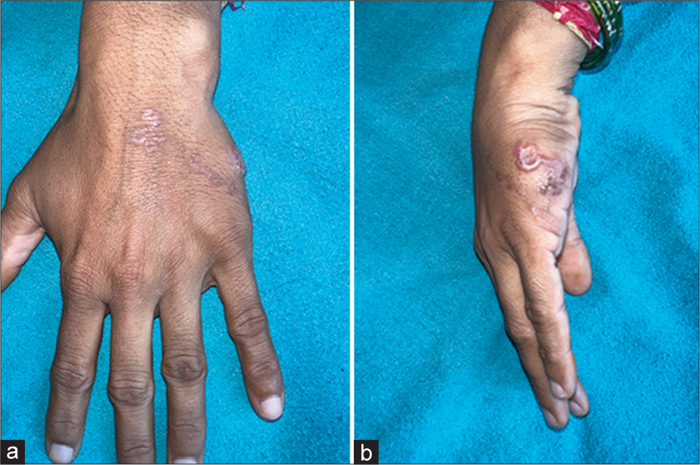 Cutaneous Larva Migrans in an Adult Female