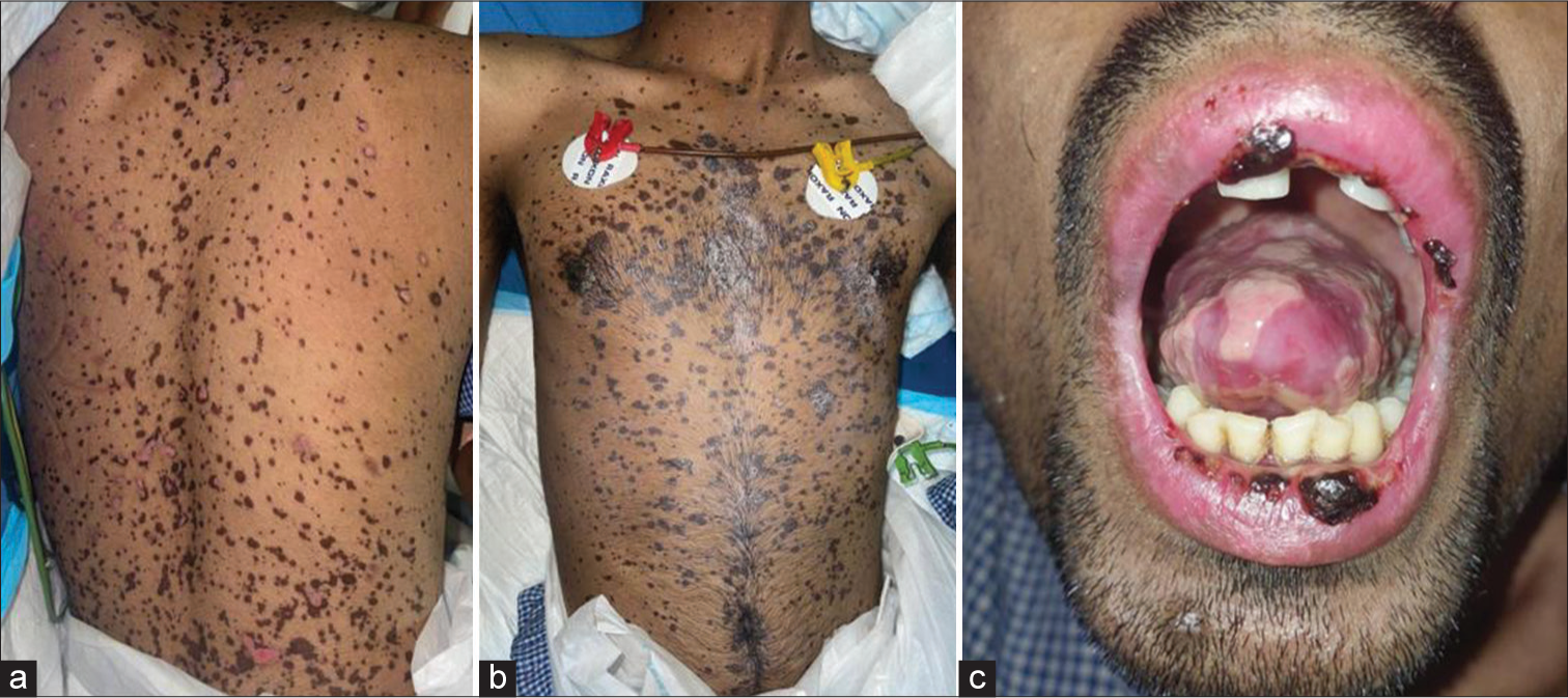 Biologics to the Rescue in Case of Stevens–Johnson Syndrome/Toxic Epidermal Necrolysis