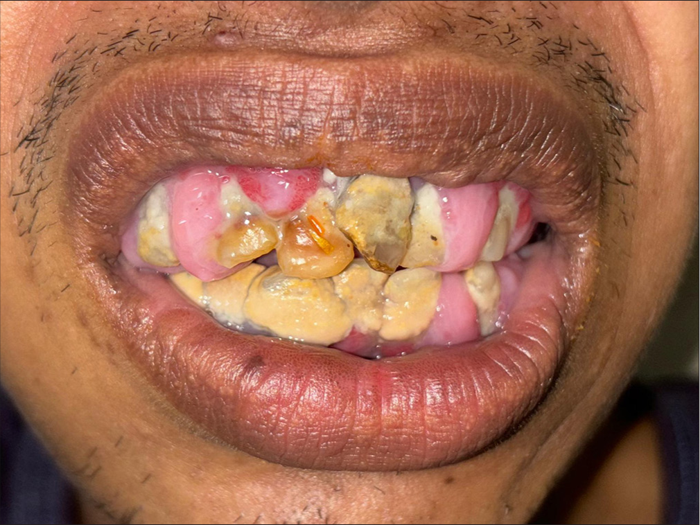 Phenytoin-Induced Gingival Enlargement