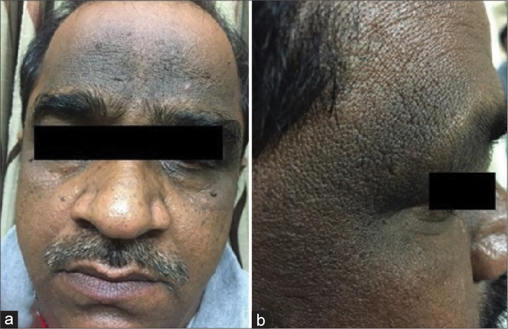 Clinical Features, Investigative Profile and Association with Metabolic Syndrome in Facial Acanthosis Nigricans: A Case–Control Study in Indian Patients