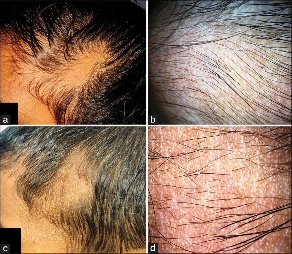 Trichoscopy: A Useful Tool in Diagnosing Temporal Triangular Alopecia