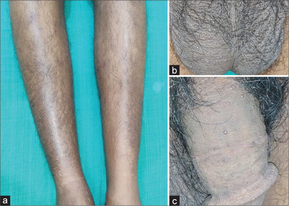 Red Dots and Dry Skin: What is More in the Store – A Rare Lysosomal Storage Disorder