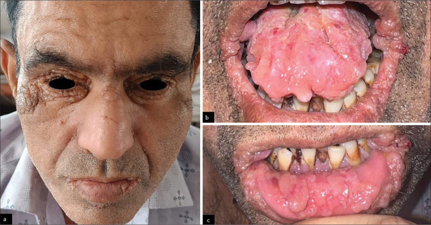 Smooth Papules, Rough Diagnosis – A Case of Primary Systemic Amyloidosis