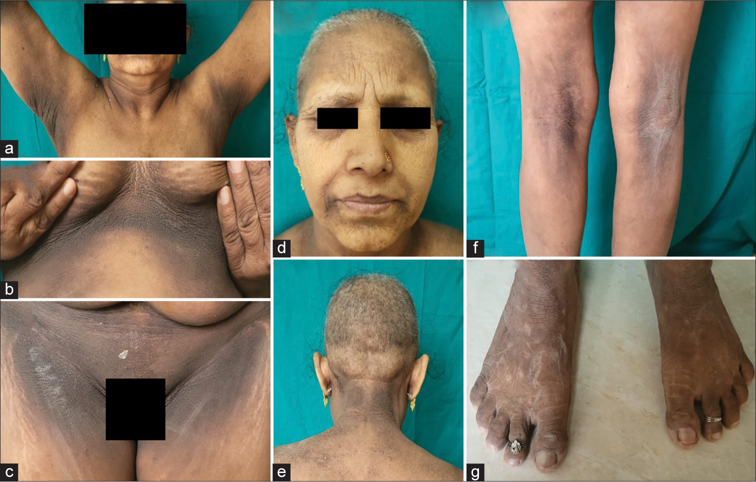 Acanthosis Nigricans as a Marker of Ovarian Carcinoma