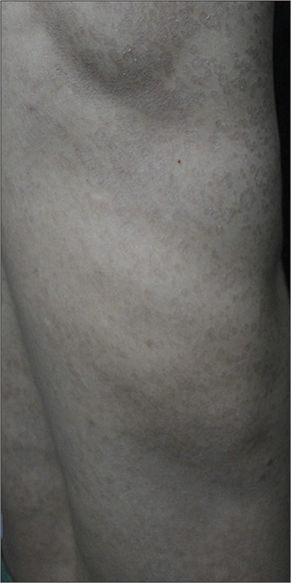 Bedside Demonstration of Fluorescence Using 365 nm Wood`s Lamp Mode of Dermoscope in Pityriasis Versicolor