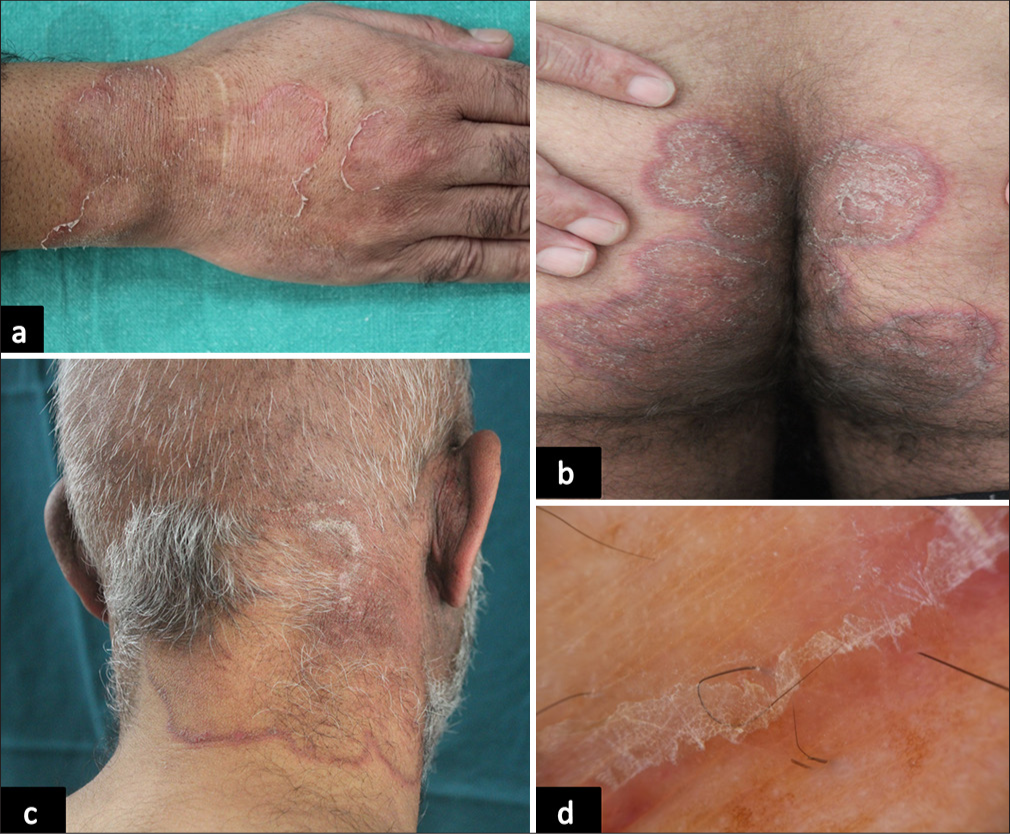 Erythema Annulare Centrifugum as Indicator of Internal Malignancy