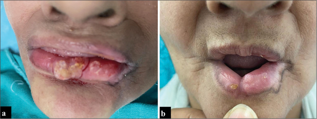 Excising Persistent Discoid Lupus Erythematosus Lesions: Nipping Evil in the Bud