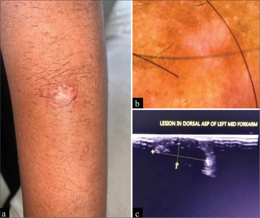 An Asymptomatic Nodular Lesion Over the Forearm – A Diagnostic Dilemma