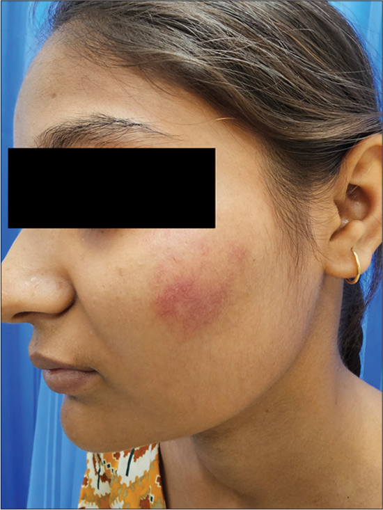 Flat Erythematous Lesion on Cheek