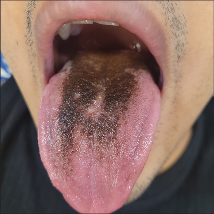 Black Hairy Tongue: An Uncommon Manifestation of Linezolid Therapy