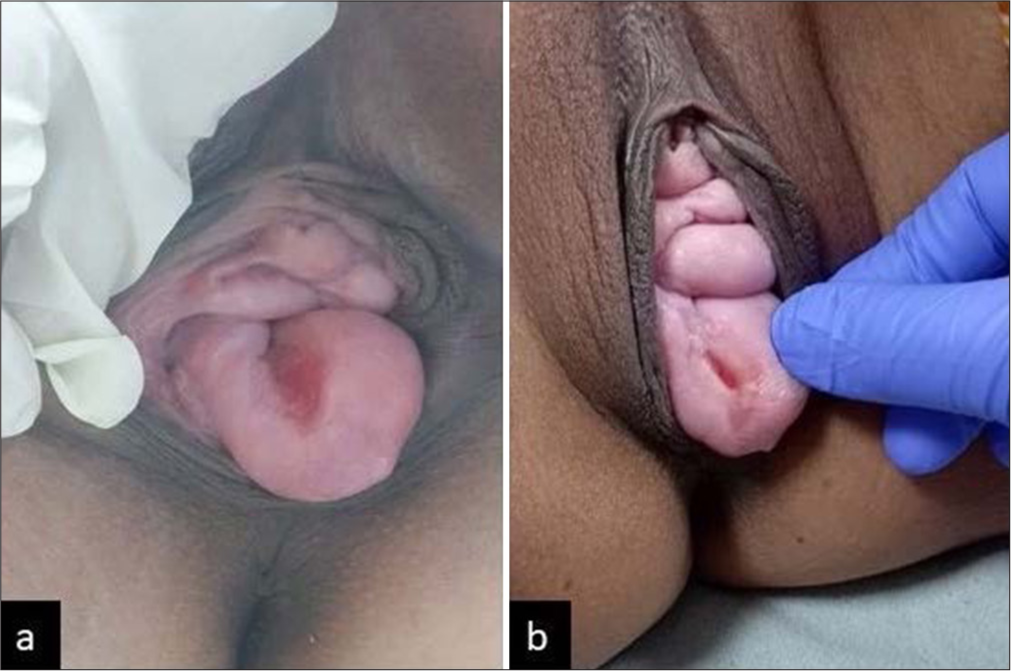 Syphilitic Primary Chancre Mimicking Decubitus Ulcer in Pelvic Organ Prolapse