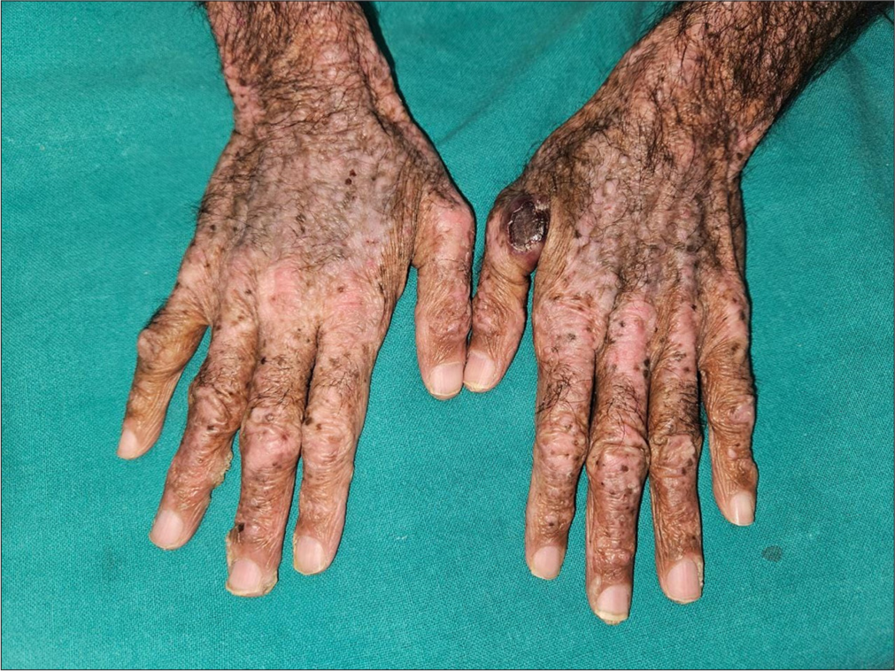 Primary Cutaneous T-cell Lymphoma – A Diagnostic Dilemma
