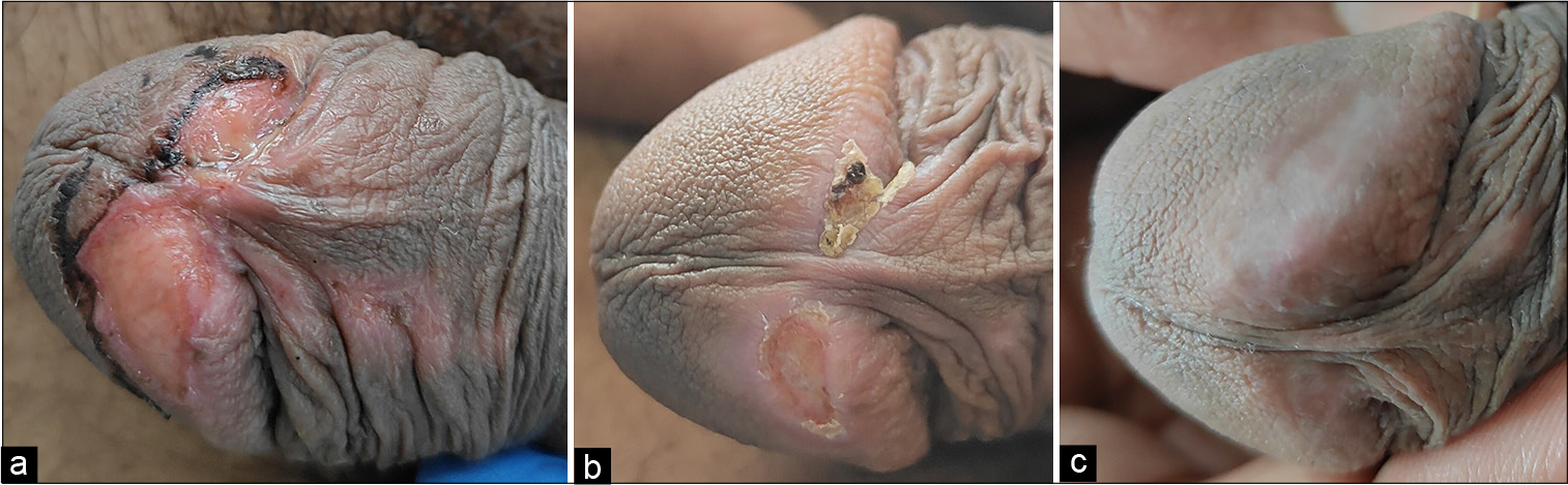 Harpitic Ulcer