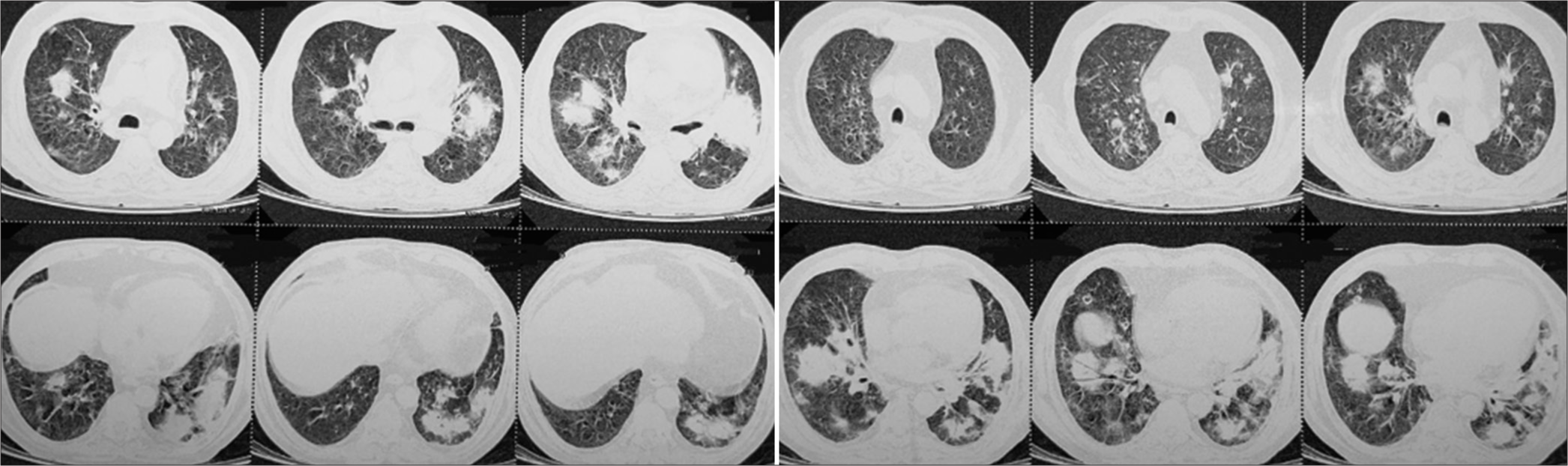 Cutaneous Alternariosis in a Patient with Pulmonary Granulomatosis with Polyangiitis (GPA): Is It a Marker of Immunosuppression or Immune Dysregulation?