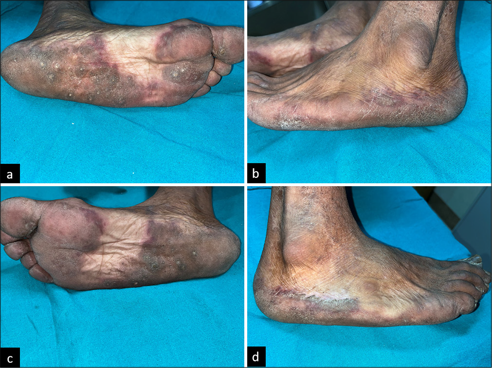 Palmoplantar Painful Pitted Keratotic Papules: A Unique Presentation of Discoid Lupus Erythematosus Coexisting with Systemic Lupus Erythematosus