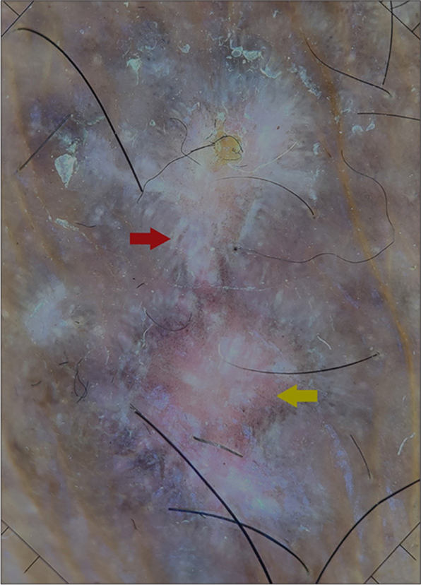 Acute Methotrexate Toxicity in a Case of Generalised Lichen Planus