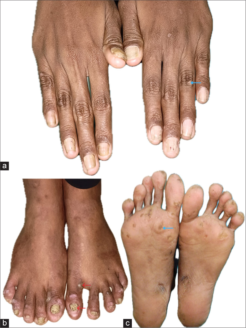 Localised Epidermolysis Bullosa Simplex in Mono-Zygotic Twins