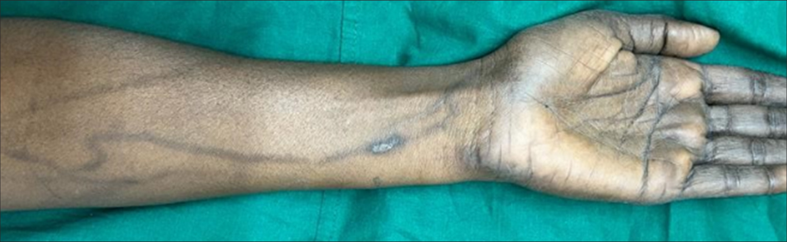 TAXANE-Induced Cutaneous Manifestations