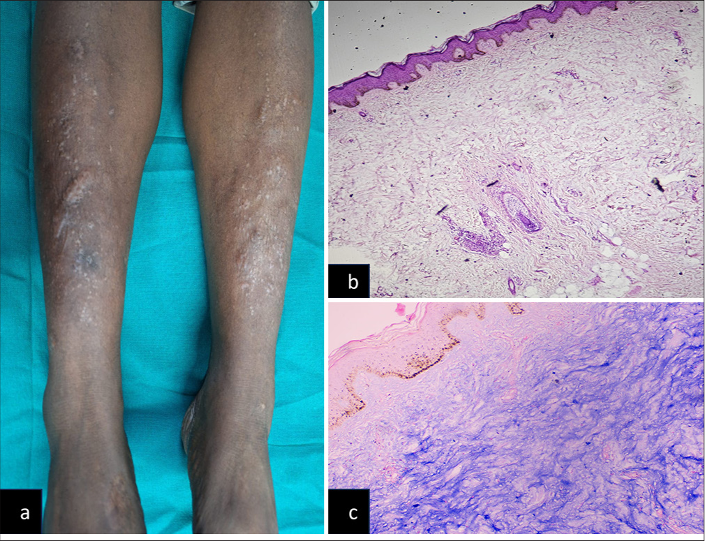 Pretibial Myxedema in a Case of Subclinical Hyperthyroidism: A Rare Presentation
