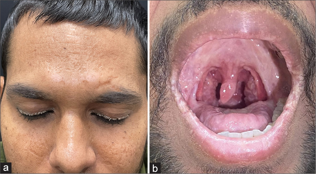 Moniliform Blepharosis in Lipoid Proteinosis