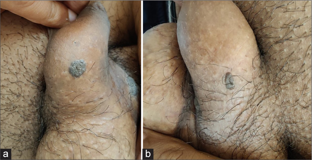 Seborrheic Keratosis with Bowenoid Transformation