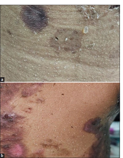 Dew Drops Over Skin: A Rare Case of Miliaria Crystallina in an Adult Female with Pemphigus Vulgaris