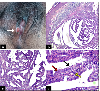 Innocence in Disguise: Vulvar Hidradenoma Papilliferum