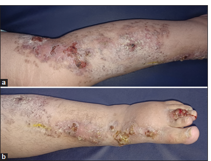 Malignant Transformation of Linear Porokeratosis