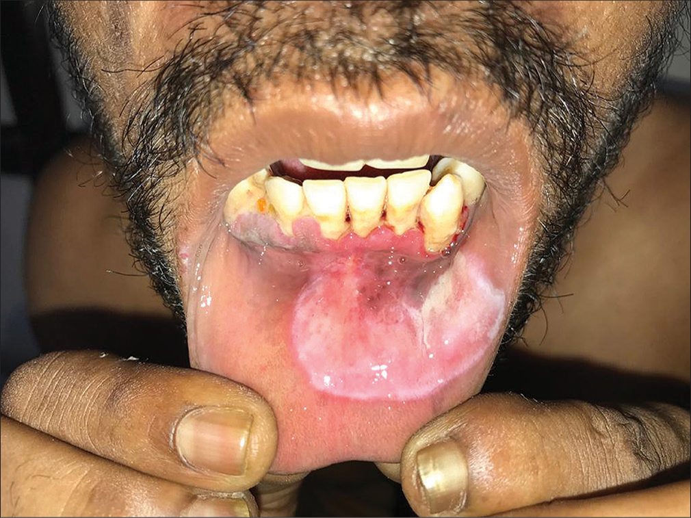 Oral Mucous Patch of Secondary Syphilis