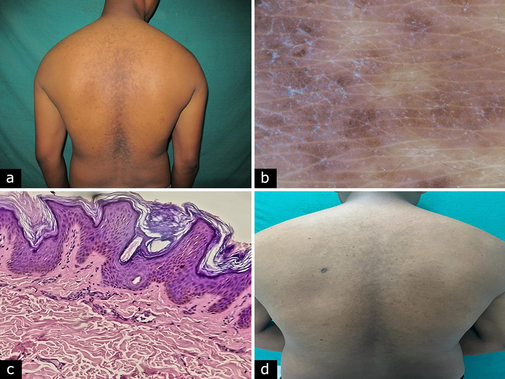 Reticulate Pigmentation Over the Back