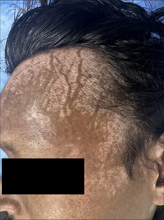 Serpentine Supravenous Hyperpigmentation – A Rare Cutaneous Manifestation of Progressive Systemic Sclerosis