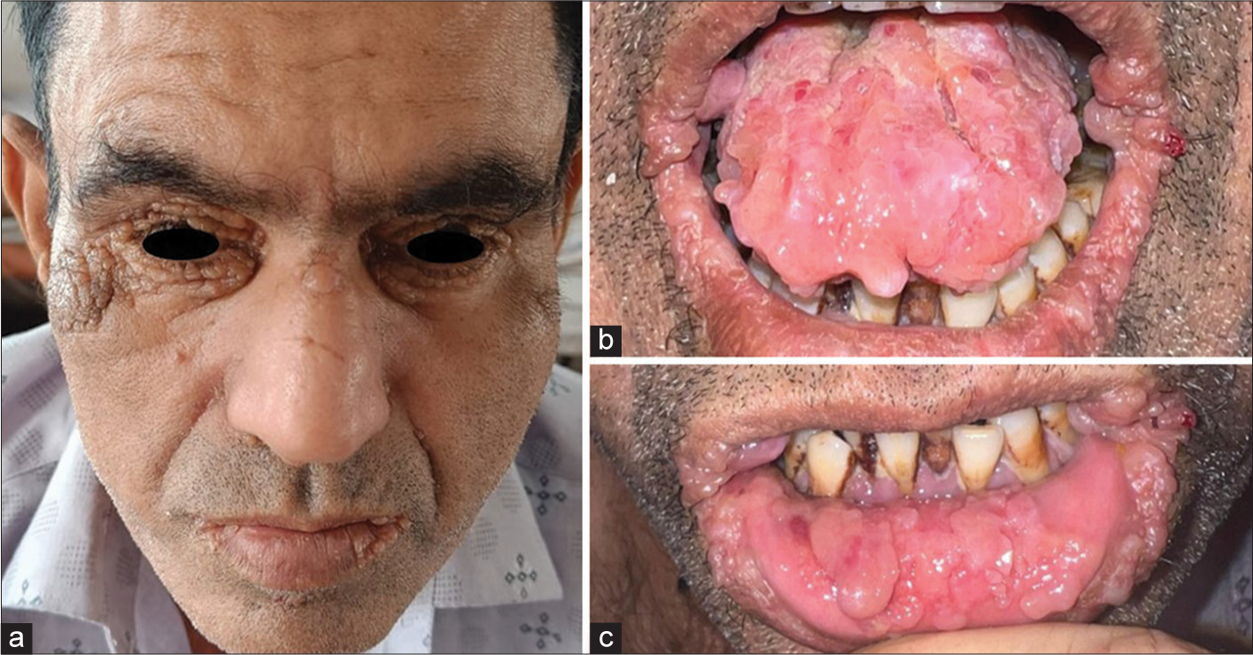 Smooth Papules, Rough Diagnosis – A Case of Primary Systemic Amyloidosis