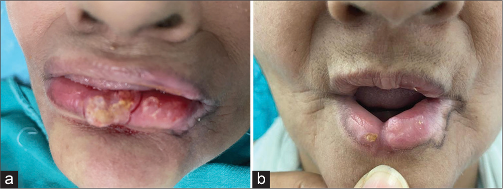 Excising Persistent Discoid Lupus Erythematosus Lesions: Nipping Evil in the Bud