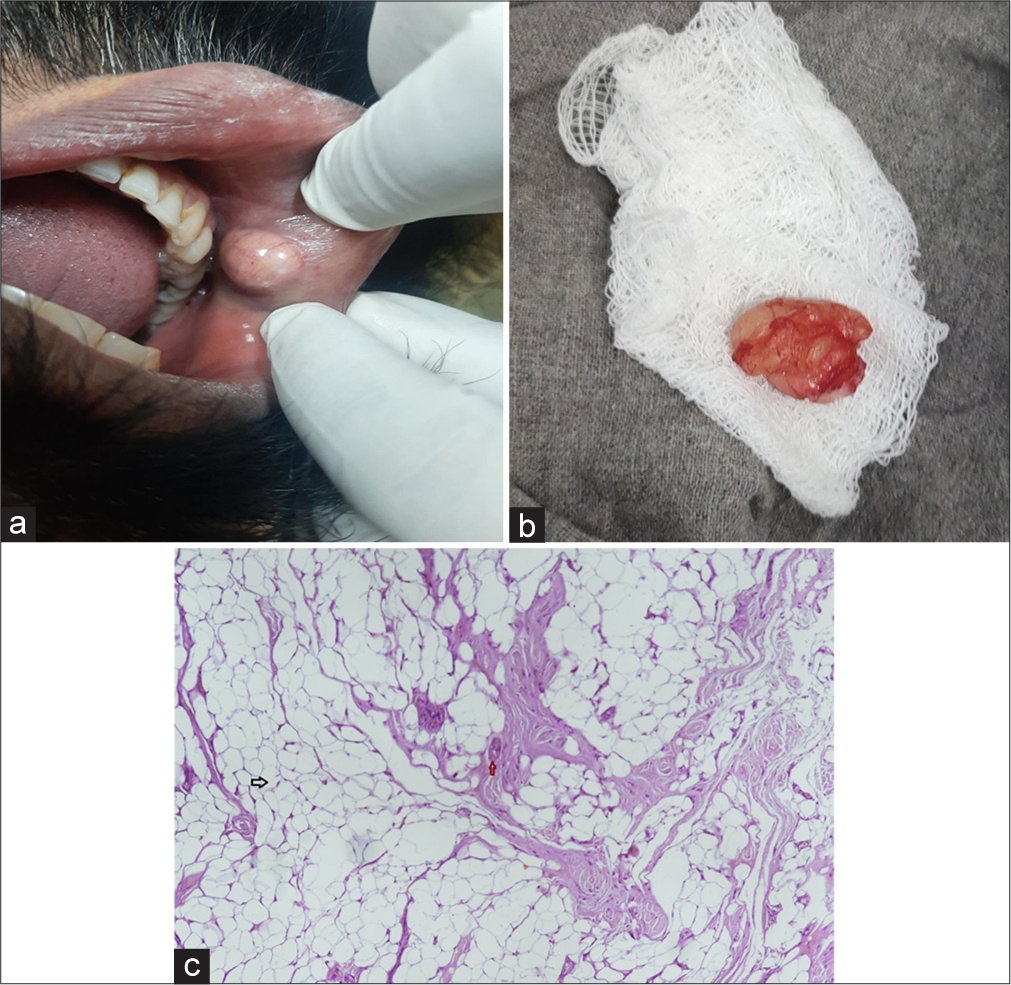 Oral Mucosal Swelling: Not all Lesions are Doomed