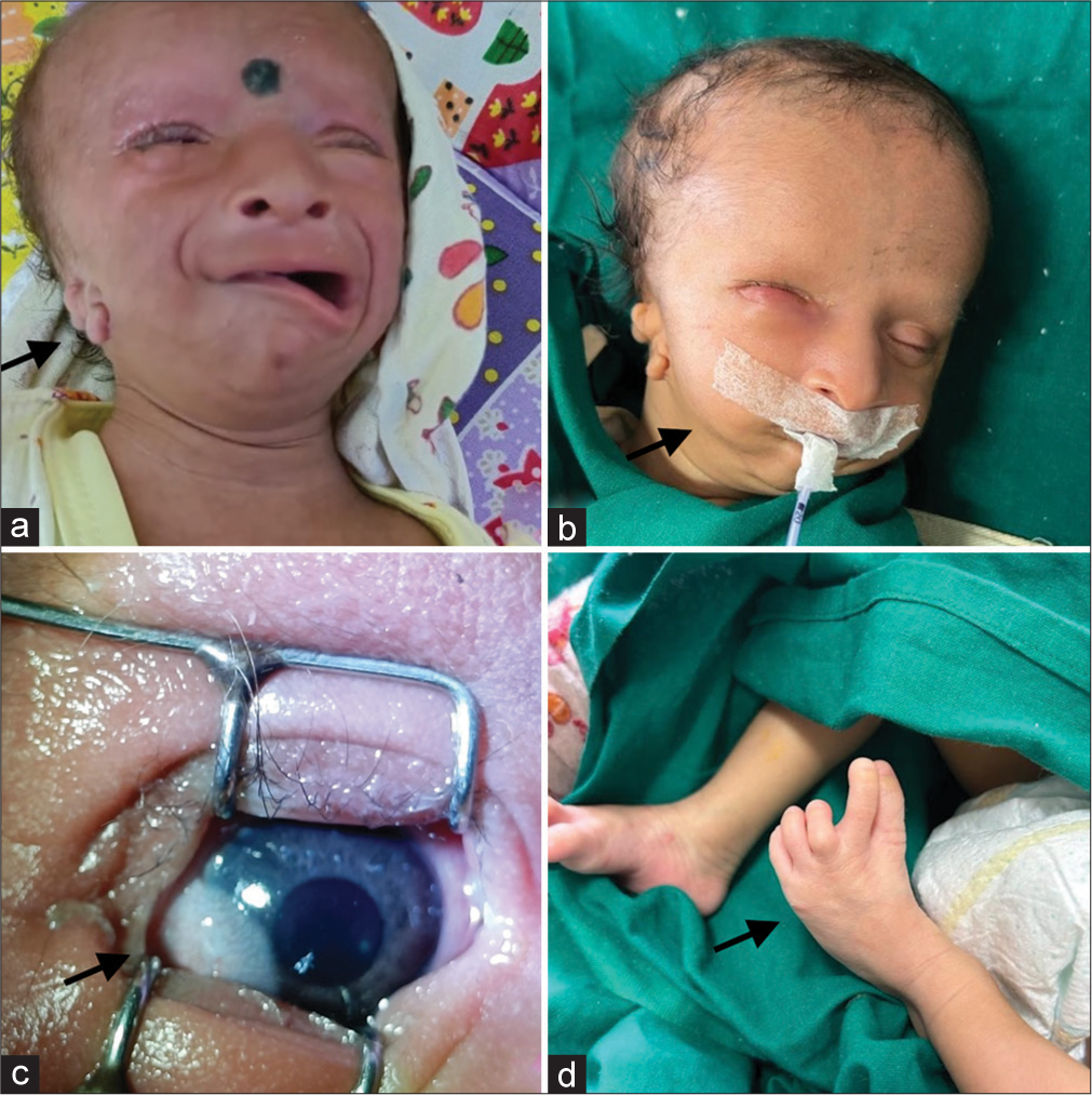 Clinical and radiological profile of a neonate with craniofacial microsomia – A case snippet