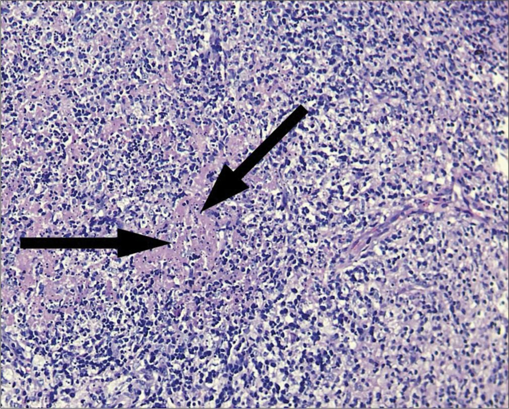 Pyrexia of unknown origin with lymphadenopathy - An uncommon diagnosis