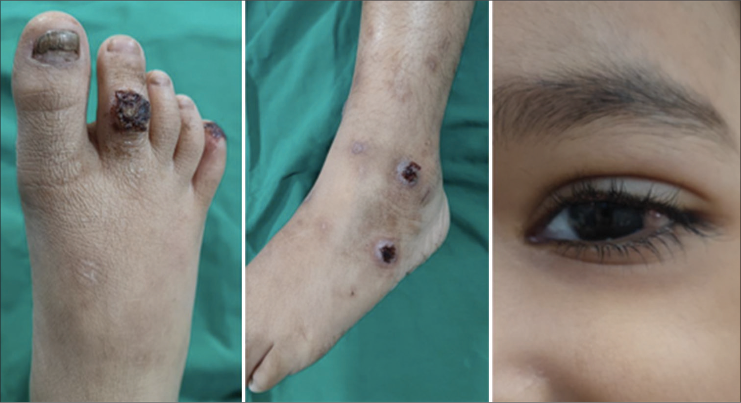Anesthetic management of a child with a laryngeal mass associated with Laryngo-onycho-cutaneous syndrome
