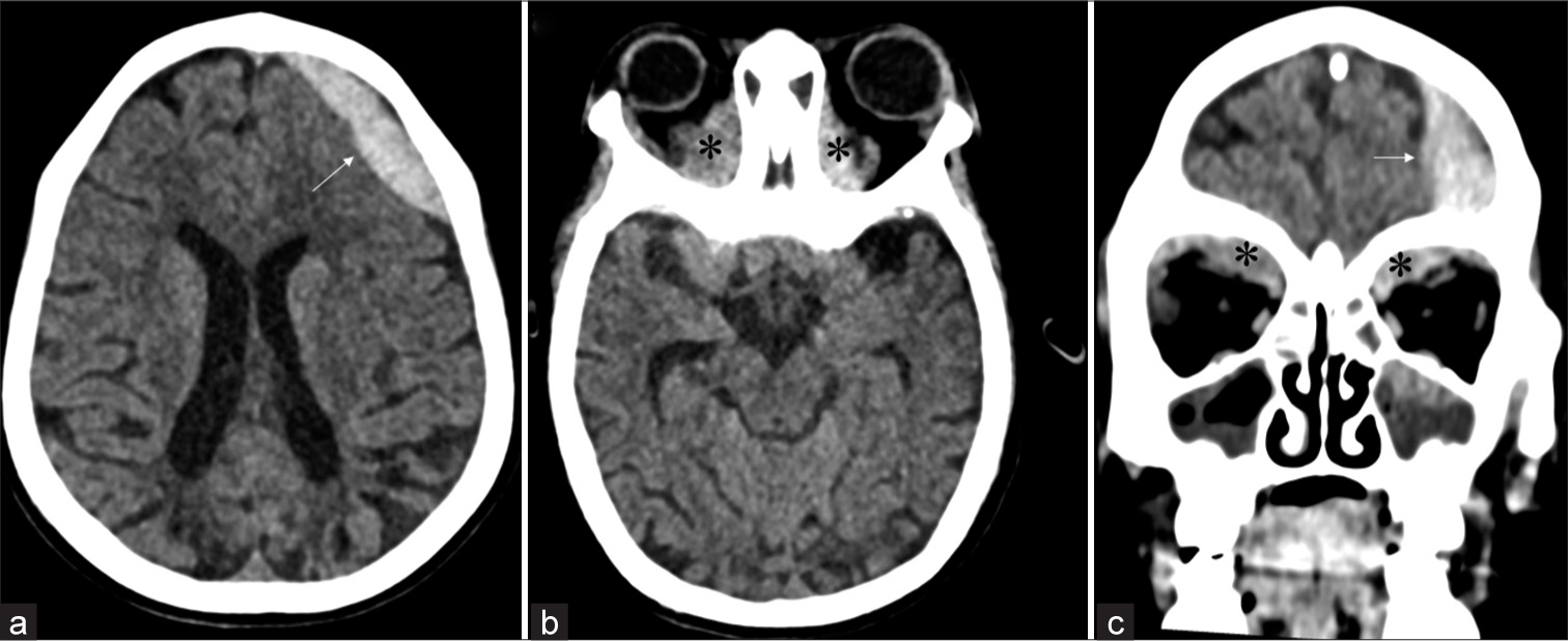 Spotting the scurvy’s sight: Spontaneous intraorbital hematomas causing bilateral acute proptosis