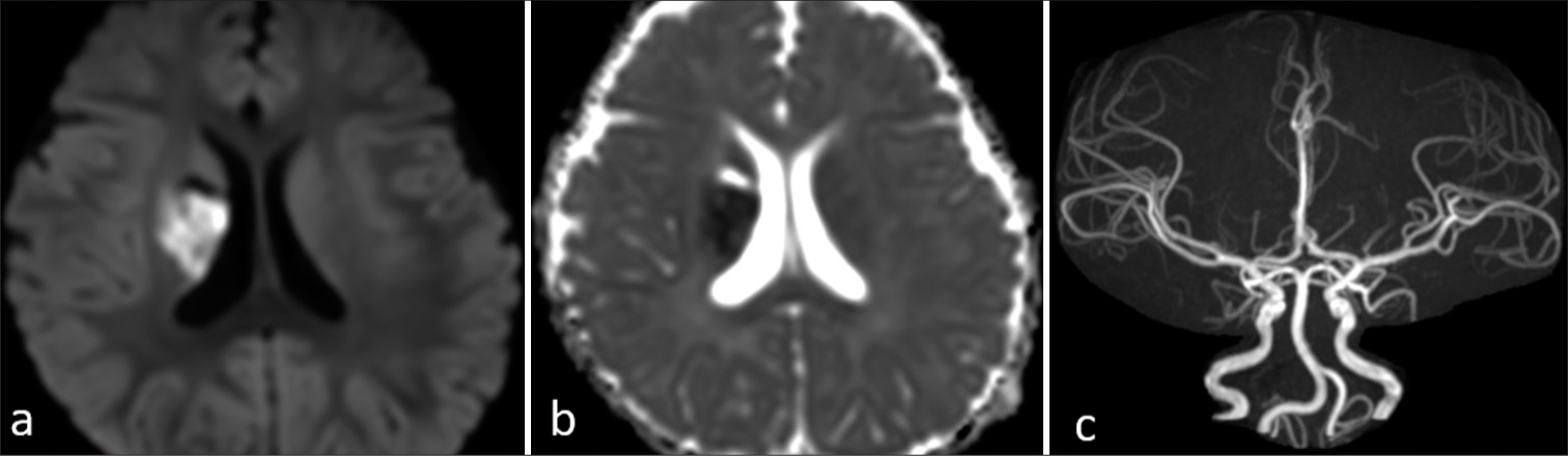 Mineralizing angiopathy with basal ganglia stroke