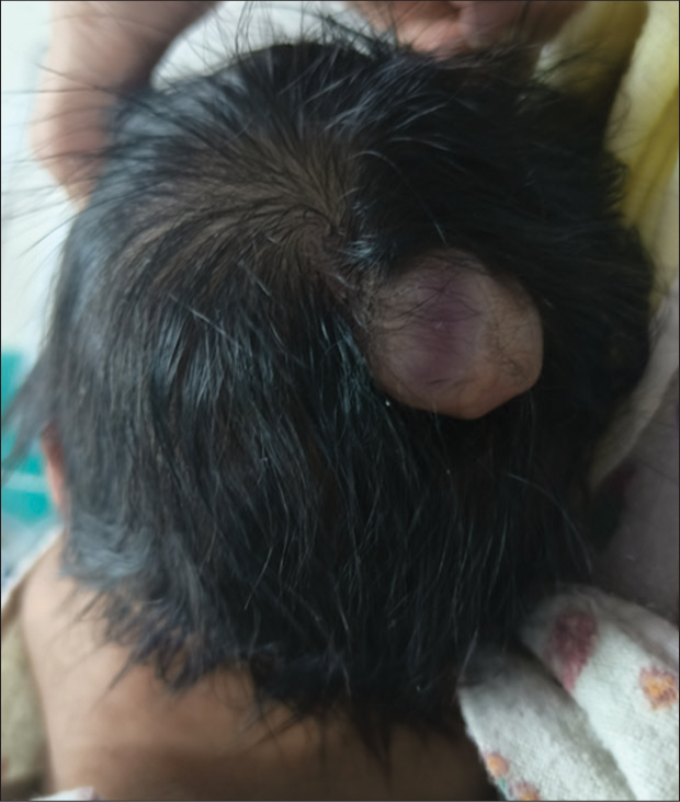 Atretic parietal cephalocele – A rare cause of scalp swelling in a newborn