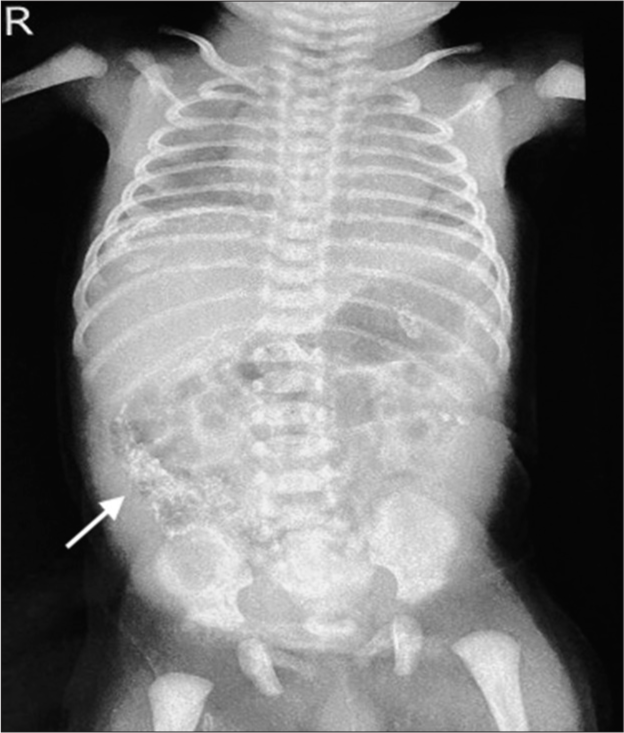 A neonate with calcifications in antenatal and postnatal ultrasound scans: A neonatologist’s perspective