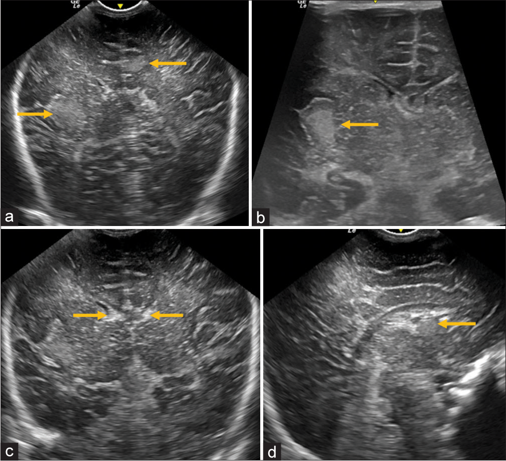 Neurosonography in cortical tubers in a case of tuberous sclerosis