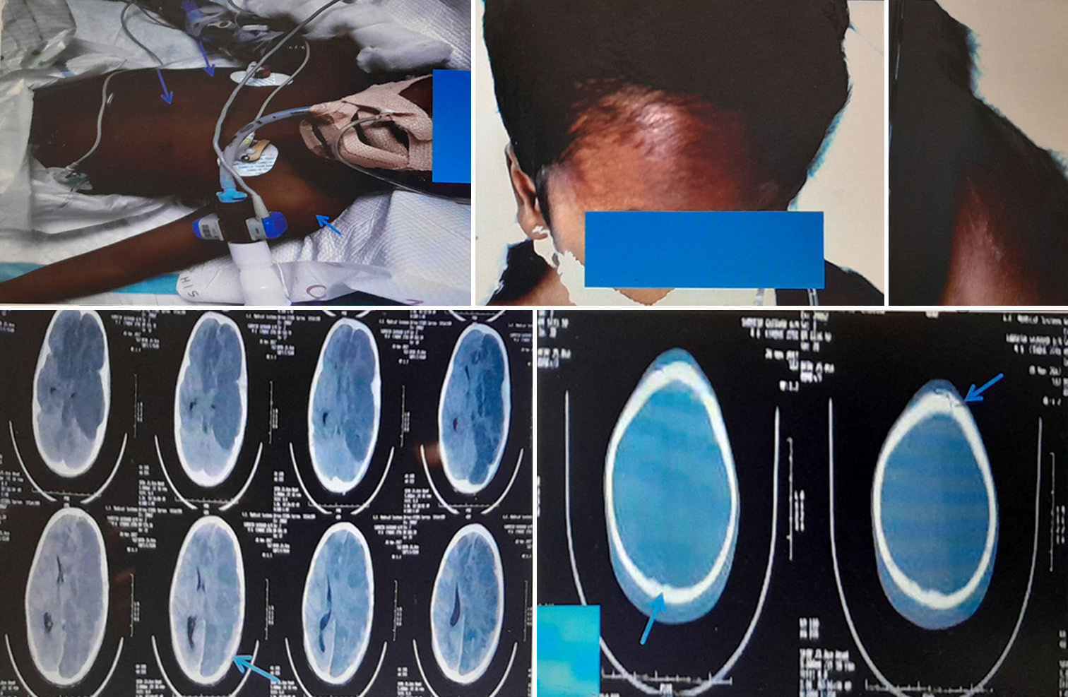Cases series of child abuse needing pediatric intensive care: Hiding in plain sight?